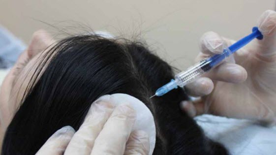 Озонотерапия от выпадения волос и для стимуляции роста волос: суть, свойства и отзывы о процедуре