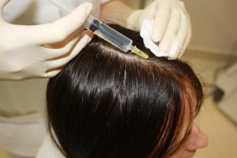 Все о мезотерапии волос. Преимущества и недостатки процедуры