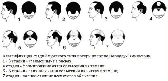 Выпадение волос у мужчин. Причины и лечение препаратами и народными средствами